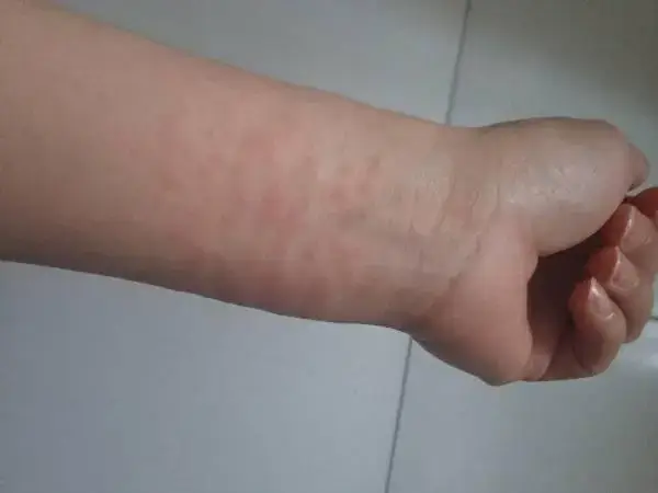 试管婴儿移植后出现红斑的原因是什么(图1)